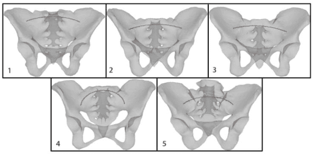 Figure 4 for An Internal Arc Fixation Channel and Automatic Planning Algorithm for Pelvic Fracture