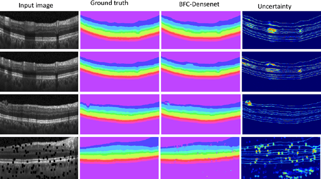 Figure 2 for Joint Segmentation and Uncertainty Visualization of Retinal Layers in Optical Coherence Tomography Images using Bayesian Deep Learning