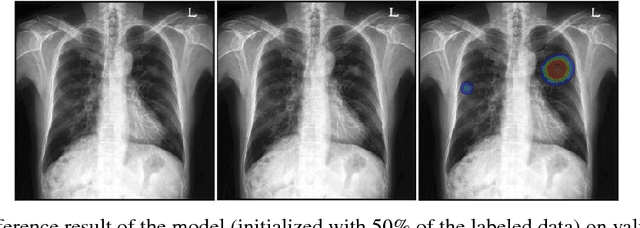 Figure 3 for Integrating Reinforcement Learning to Self Training for Pulmonary Nodule Segmentation in Chest X-rays