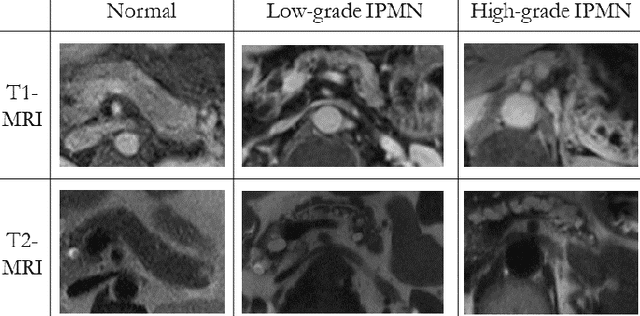 Figure 1 for INN: Inflated Neural Networks for IPMN Diagnosis