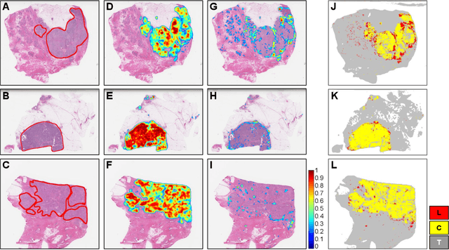 Figure 4 for Utilizing Automated Breast Cancer Detection to Identify Spatial Distributions of Tumor Infiltrating Lymphocytes in Invasive Breast Cancer