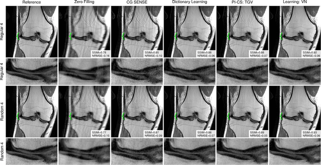 Figure 3 for Learning a Variational Network for Reconstruction of Accelerated MRI Data