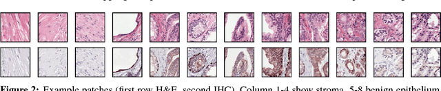 Figure 3 for Unsupervised Prostate Cancer Detection on H&E using Convolutional Adversarial Autoencoders