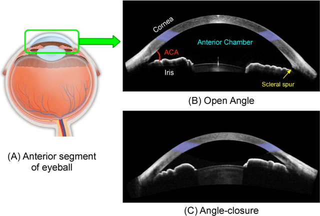 Figure 1 for Angle-Closure Detection in Anterior Segment OCT based on Multi-Level Deep Network