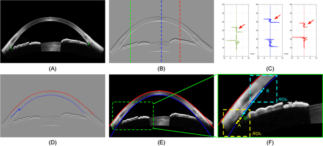 Figure 4 for Angle-Closure Detection in Anterior Segment OCT based on Multi-Level Deep Network