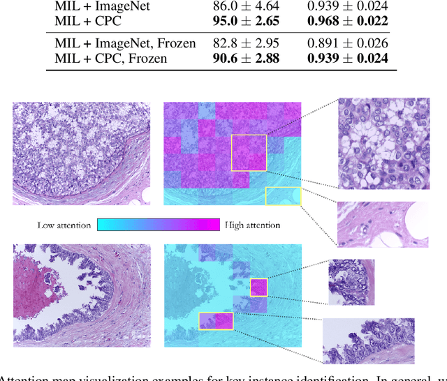 Figure 3 for Semi-Supervised Histology Classification using Deep Multiple Instance Learning and Contrastive Predictive Coding