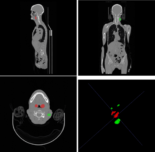 Figure 1 for Automated head and neck tumor segmentation from 3D PET/CT