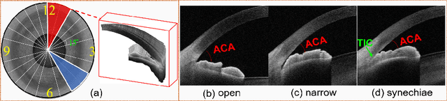 Figure 1 for Open-Narrow-Synechiae Anterior Chamber Angle Classification in AS-OCT Sequences