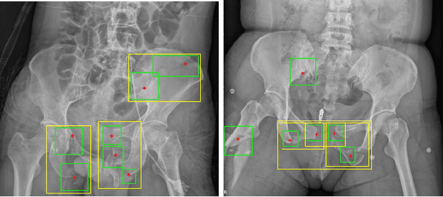 Figure 1 for A New Window Loss Function for Bone Fracture Detection and Localization in X-ray Images with Point-based Annotation