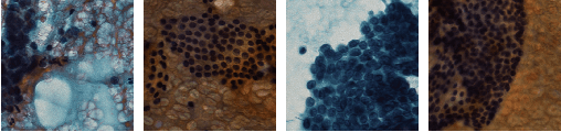 Figure 1 for Highly Efficient Follicular Segmentation in Thyroid Cytopathological Whole Slide Image