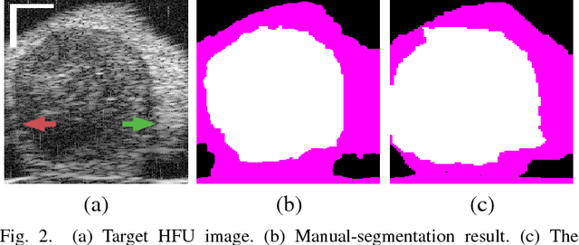 Figure 4 for Segmentation of 3D High-frequency Ultrasound Images of Human Lymph Nodes Using Graph Cut with Energy Functional Adapted to Local Intensity Distribution