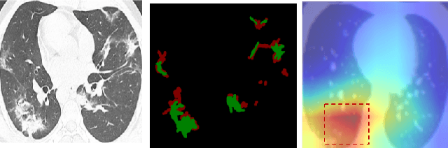 Figure 1 for Attention with Multiple Sources Knowledges for COVID-19 from CT Images