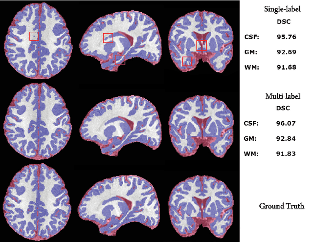 Figure 4 for Exclusive Independent Probability Estimation using Deep 3D Fully Convolutional DenseNets for IsoIntense Infant Brain MRI Segmentation