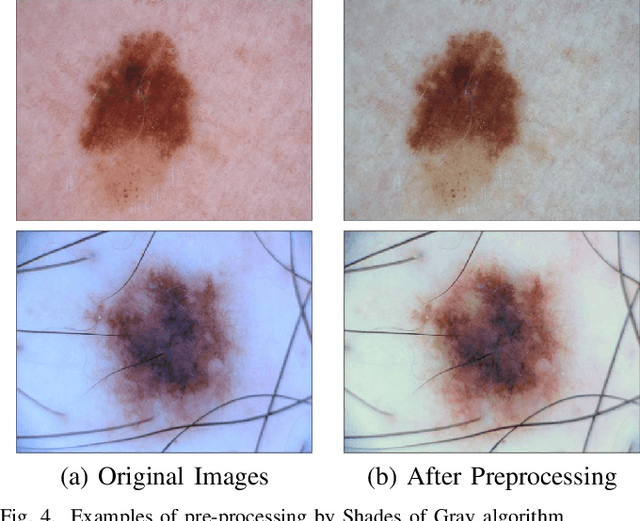 Figure 4 for Automatic Lesion Boundary Segmentation in Dermoscopic Images with Ensemble Deep Learning Methods