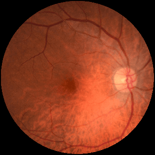 Figure 3 for The relationship between Fully Connected Layers and number of classes for the analysis of retinal images