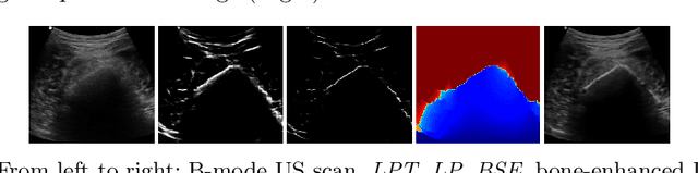 Figure 2 for Simultaneous Segmentation and Classification of Bone Surfaces from Ultrasound Using a Multi-feature Guided CNN