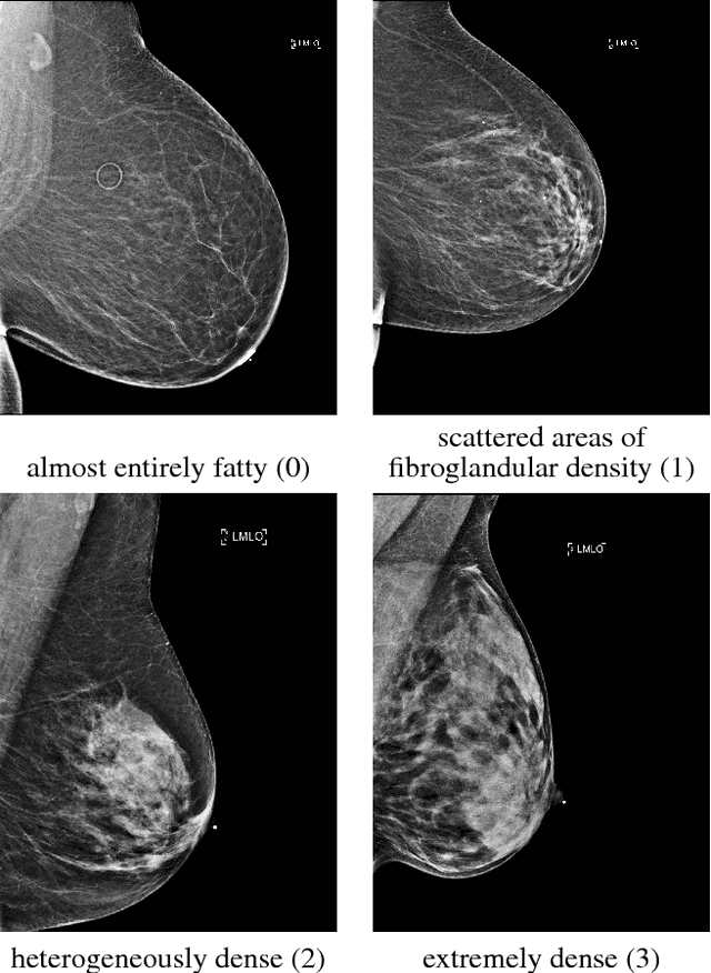 Figure 1 for Breast density classification with deep convolutional neural networks