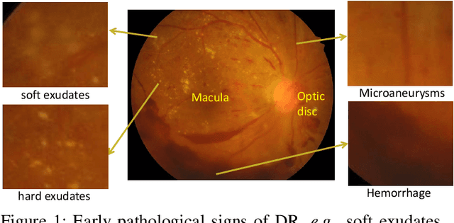 Figure 1 for CANet: Cross-disease Attention Network for Joint Diabetic Retinopathy and Diabetic Macular Edema Grading