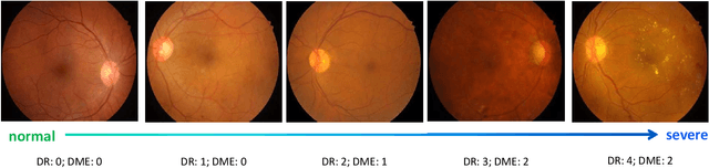 Figure 2 for CANet: Cross-disease Attention Network for Joint Diabetic Retinopathy and Diabetic Macular Edema Grading