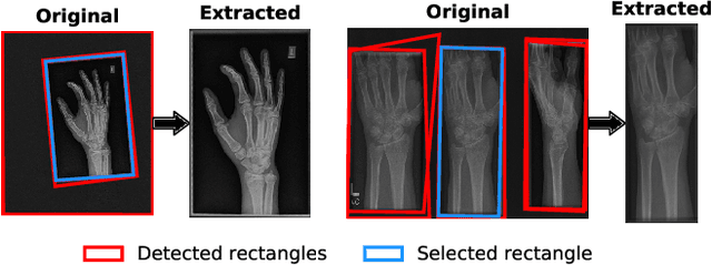 Figure 4 for Self-Taught Semi-Supervised Anomaly Detection on Upper Limb X-rays