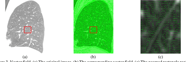 Figure 4 for Pulmonary Fissure Segmentation in CT Images Based on ODoS Filter and Shape Features