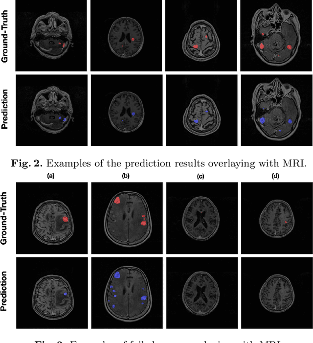 Figure 4 for Multimodal Volume-Aware Detection and Segmentation for Brain Metastases Radiosurgery