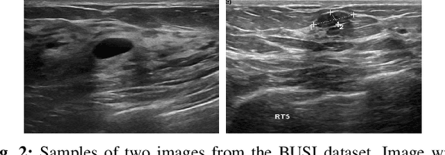 Figure 2 for Comparison of different CNNs for breast tumor classification from ultrasound images