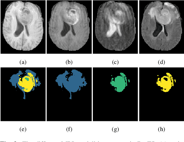 Figure 4 for Pseudo-label refinement using superpixels for semi-supervised brain tumour segmentation