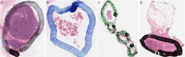 Figure 3 for Restoration of marker occluded hematoxylin and eosin stained whole slide histology images using generative adversarial networks