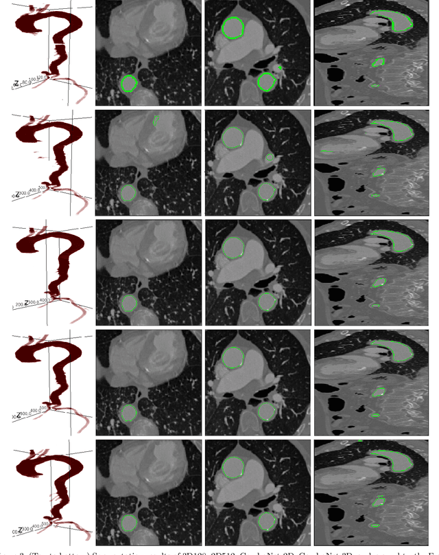 Figure 4 for ComboNet: Combined 2D & 3D Architecture for Aorta Segmentation