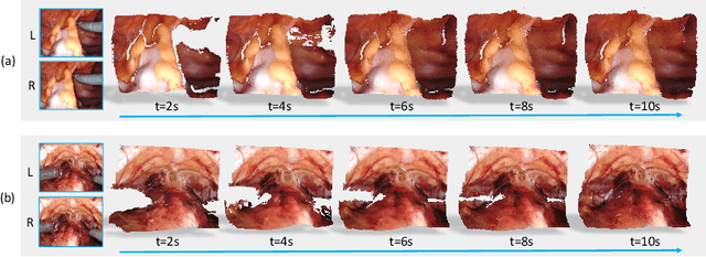 Figure 3 for E-DSSR: Efficient Dynamic Surgical Scene Reconstruction with Transformer-based Stereoscopic Depth Perception