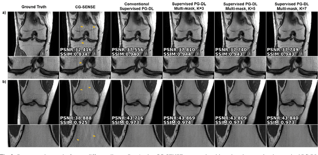Figure 4 for Improved Supervised Training of Physics-Guided Deep Learning Image Reconstruction with Multi-Masking