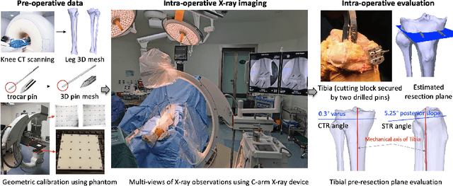 Figure 1 for SLAM-TKA: Real-time Intra-operative Measurement of Tibial Resection Plane in Conventional Total Knee Arthroplasty