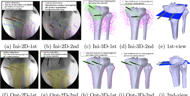 Figure 4 for SLAM-TKA: Real-time Intra-operative Measurement of Tibial Resection Plane in Conventional Total Knee Arthroplasty