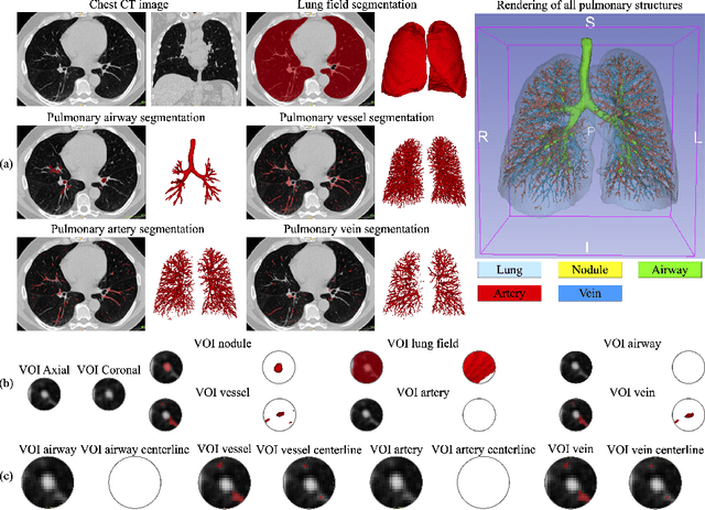 Figure 2 for Relationship between pulmonary nodule malignancy and surrounding pleurae, airways and vessels: a quantitative study using the public LIDC-IDRI dataset