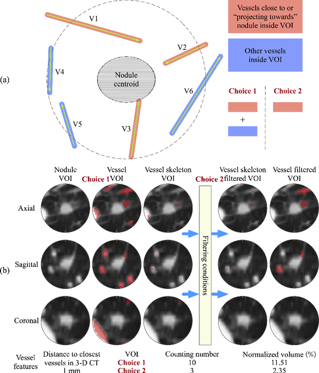 Figure 4 for Relationship between pulmonary nodule malignancy and surrounding pleurae, airways and vessels: a quantitative study using the public LIDC-IDRI dataset