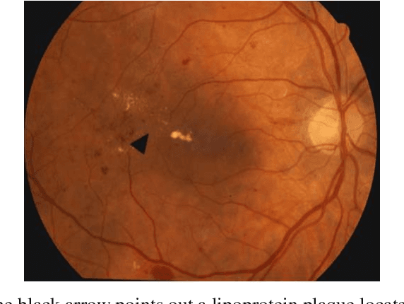 Figure 1 for Diabetic Retinopathy Diagnosis based on Convolutional Neural Network