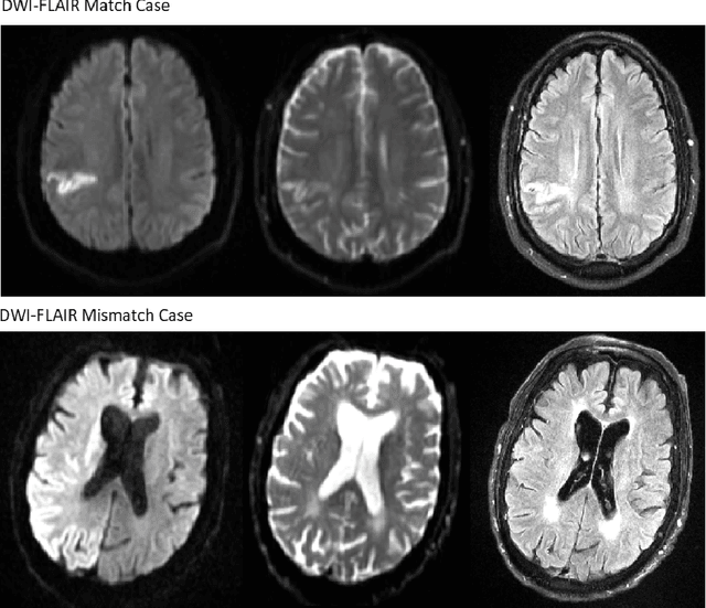 Figure 1 for Intra-Domain Task-Adaptive Transfer Learning to Determine Acute Ischemic Stroke Onset Time