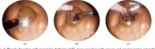 Figure 4 for Virtual Reality Simulator for Fetoscopic Spina Bifida Repair Surgery