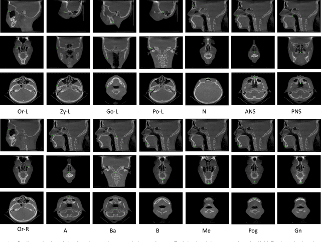 Figure 4 for Structure-Aware Long Short-Term Memory Network for 3D Cephalometric Landmark Detection