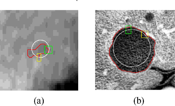 Figure 3 for Adaptive Local Window for Level Set Segmentation of CT and MRI Liver Lesions