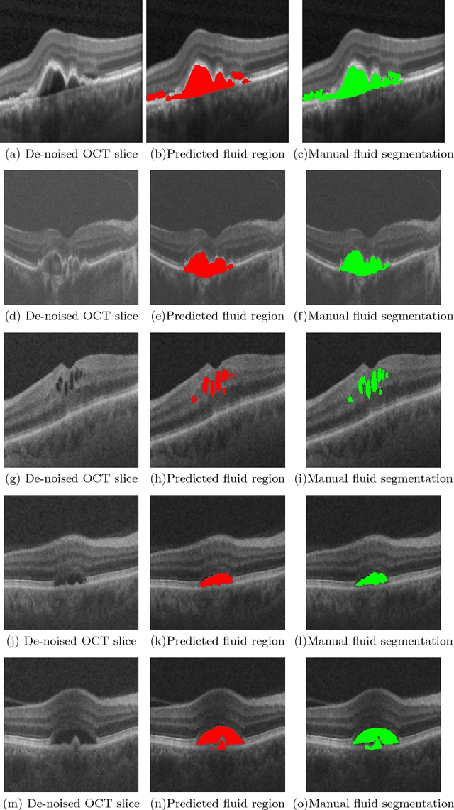 Figure 4 for A Generalized Motion Pattern and FCN based approach for retinal fluid detection and segmentation