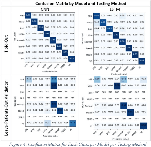 Figure 4 for Improving ECG Classification Interpretability using Saliency Maps