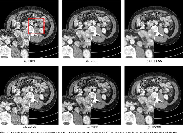 Figure 4 for EDCNN: Edge enhancement-based Densely Connected Network with Compound Loss for Low-Dose CT Denoising