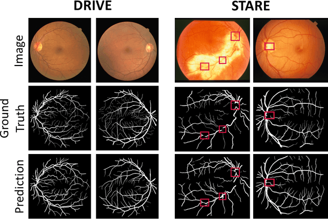 Figure 4 for EAR-NET: Error Attention Refining Network For Retinal Vessel Segmentation