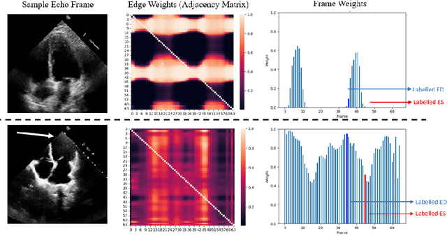 Figure 4 for EchoGNN: Explainable Ejection Fraction Estimation with Graph Neural Networks