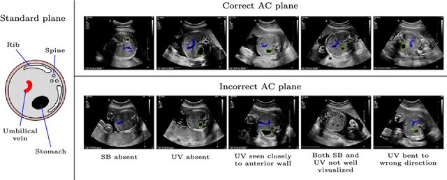 Figure 1 for Automatic Estimation of Fetal Abdominal Circumference from Ultrasound Images