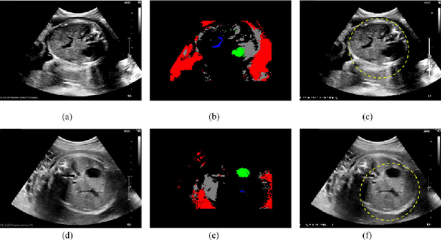 Figure 3 for Automatic Estimation of Fetal Abdominal Circumference from Ultrasound Images