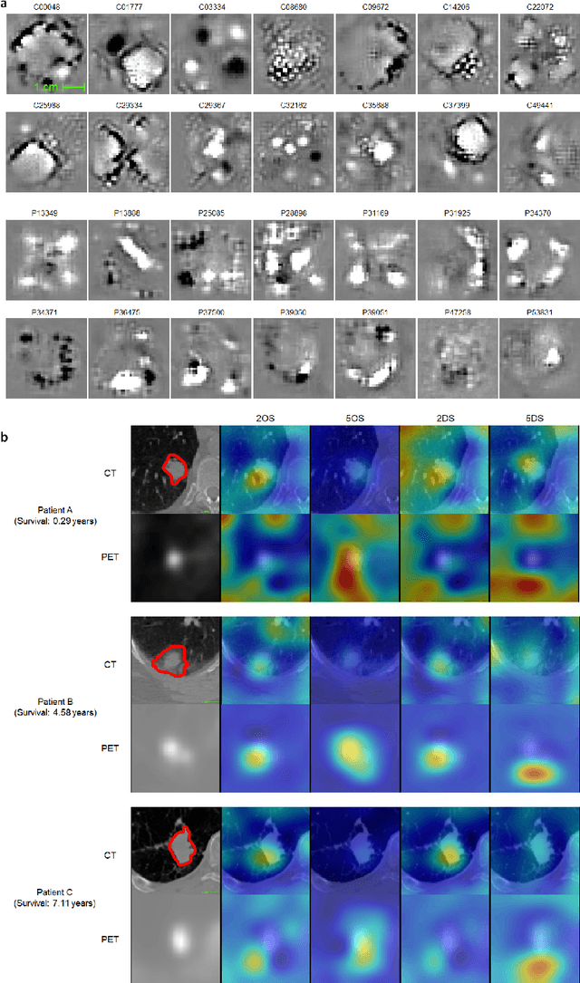 Figure 4 for What does AI see? Deep segmentation networks discover biomarkers for lung cancer survival