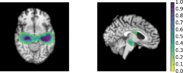 Figure 4 for Residual and Plain Convolutional Neural Networks for 3D Brain MRI Classification